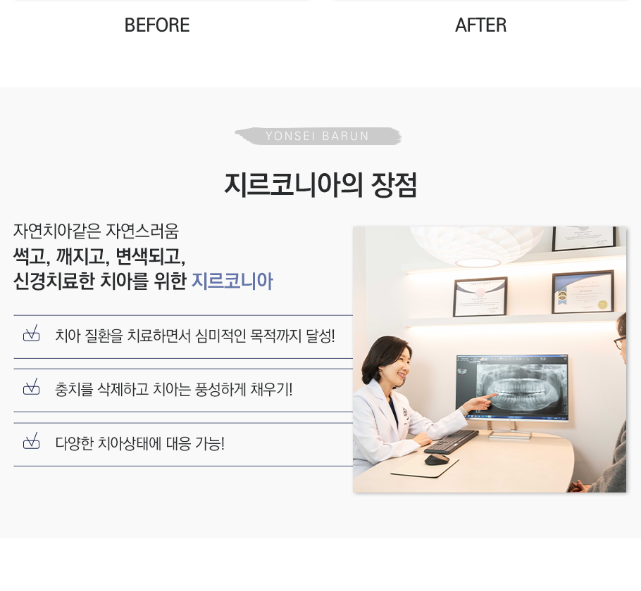 지르코니아