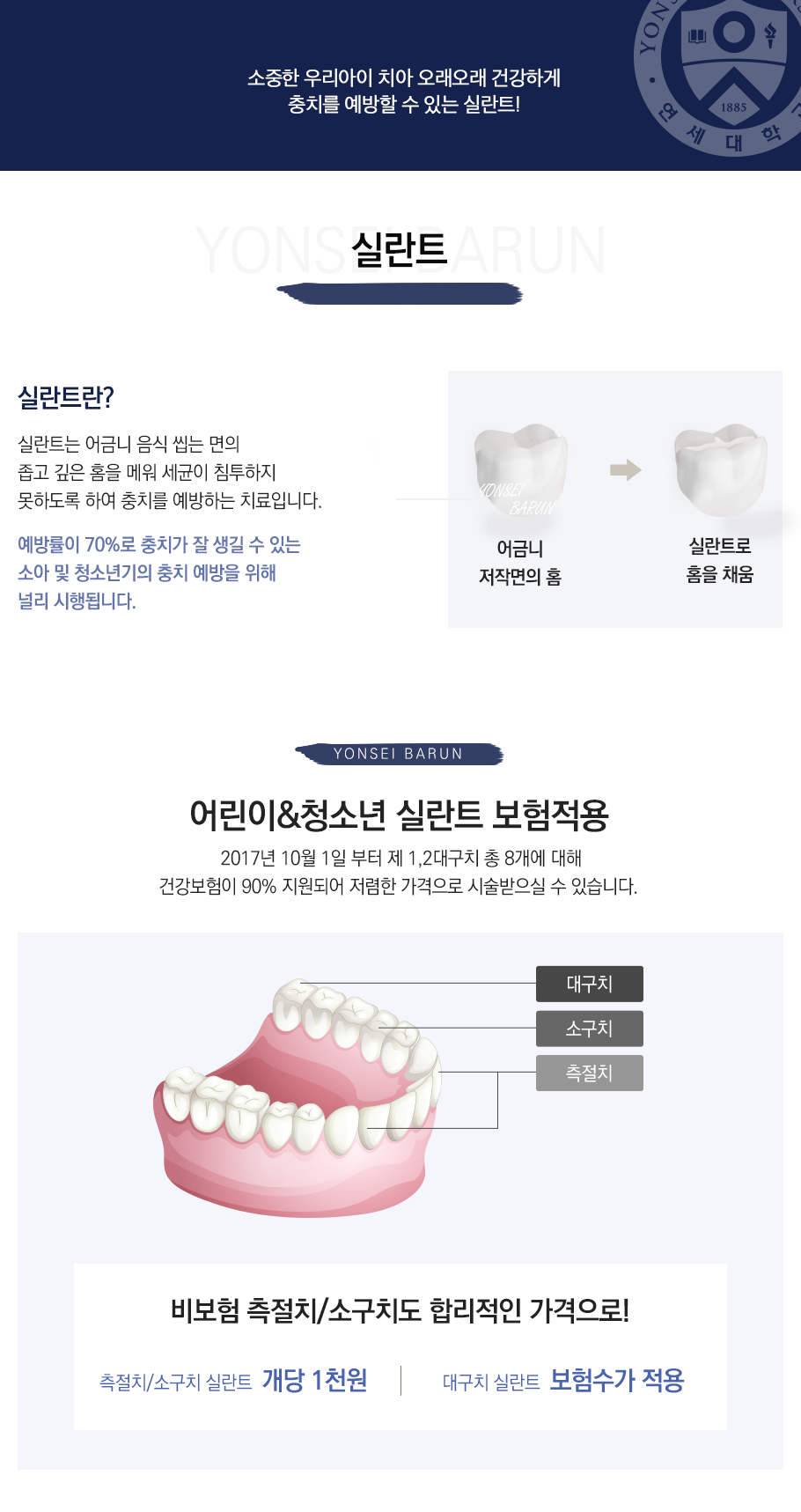 실란트